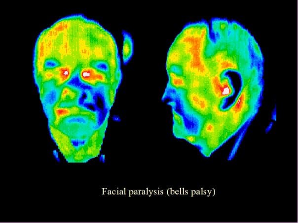 Bells Palsy, thermography