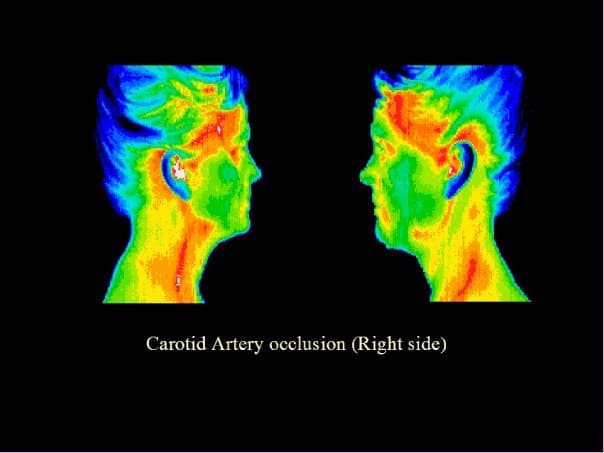carotid artery, occlusion, blockage, thermography