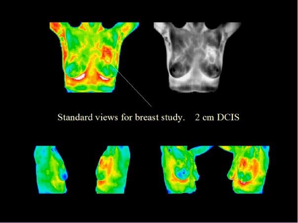 breast cancer, DCIS, thermography