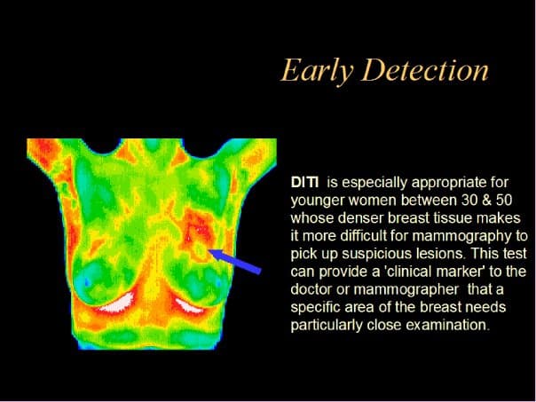 thermography, young women, breast imaging