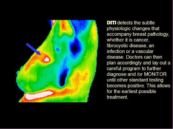 thermography, breast imaging, early detection, breast cancer