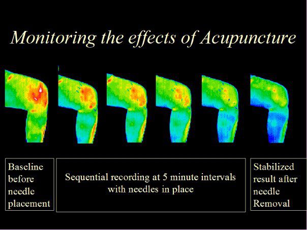 acupuncture, benefits, thermography