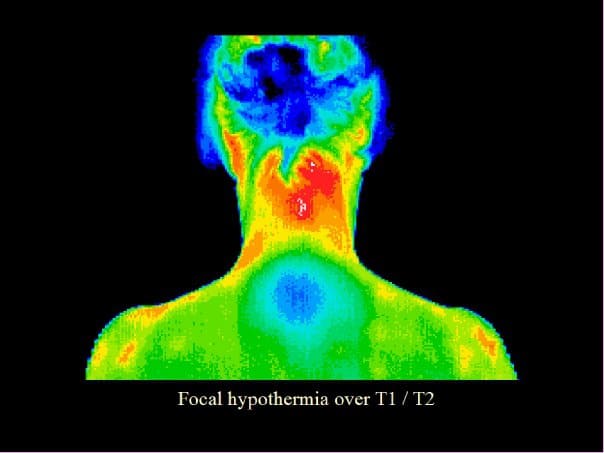 focal hypothermia, T1, T2, autoimmune conditions