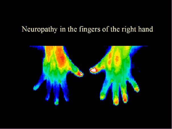neuropathy, right hand, thermography, imaging