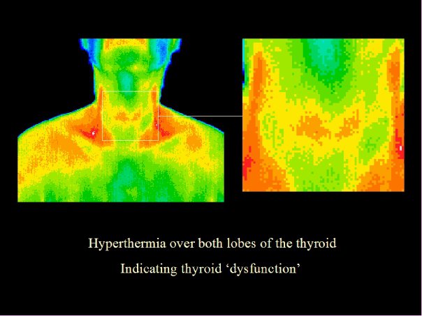 Thyroid dysfunction, thermography